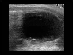 Large anechoic cyst and multiple peripheral follicular cysts