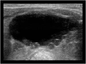 Large anechoic cyst and multiple peripheral follicular cysts