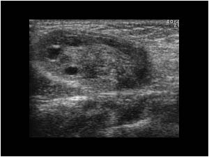 Inguinal hernia containing the right ovary