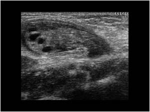 Inguinal hernia containing the right ovary