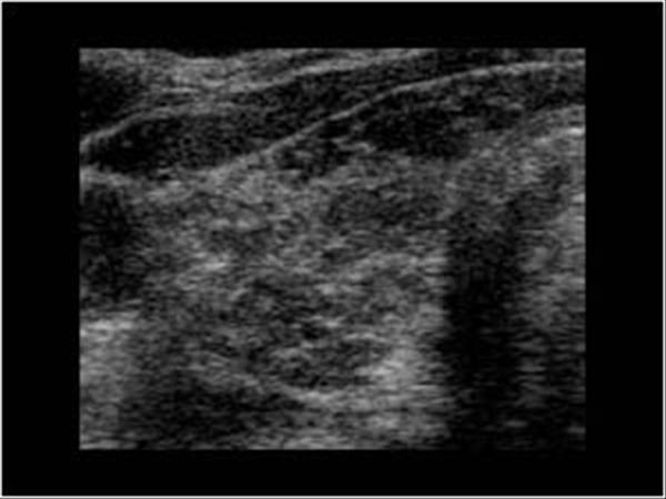 thyroiditis ultrasound pictures