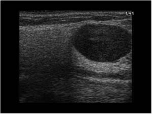 pleomorphic adenoma submandibular gland ultrasound)