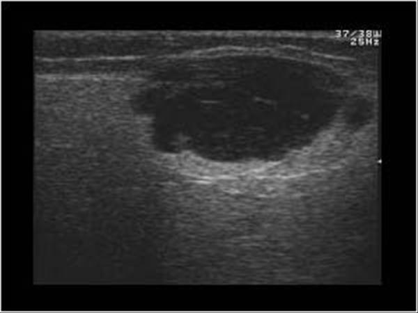 parotid gland tumor ultrasound