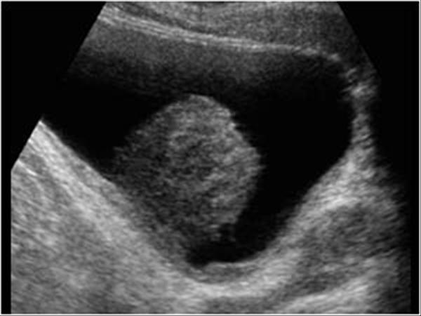 Transitional Cell Carcinoma Bladder Ultrasound