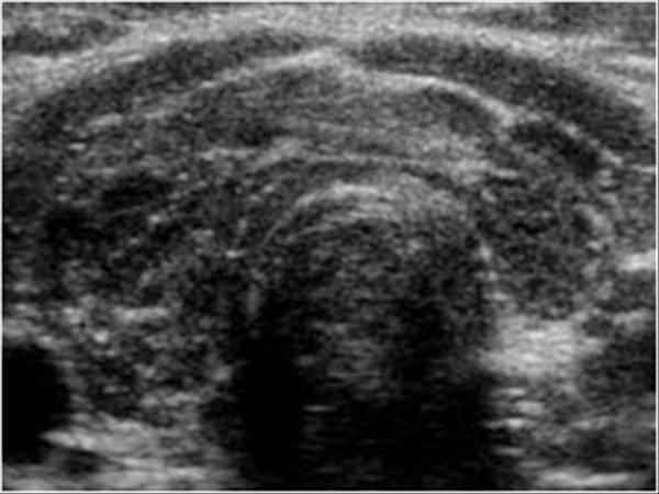autoimmune thyroiditis ultrasound