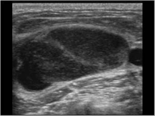 Head and Neck | 4.4 Lymph nodes : Case 4.4.1 Benign lymph nodes