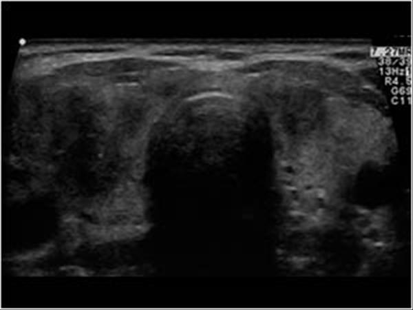 ultrasound findings subacute thyroiditis