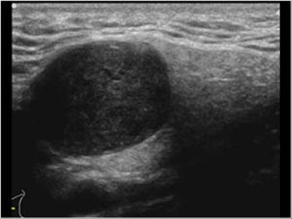 pleomorphic adenoma ultrasound