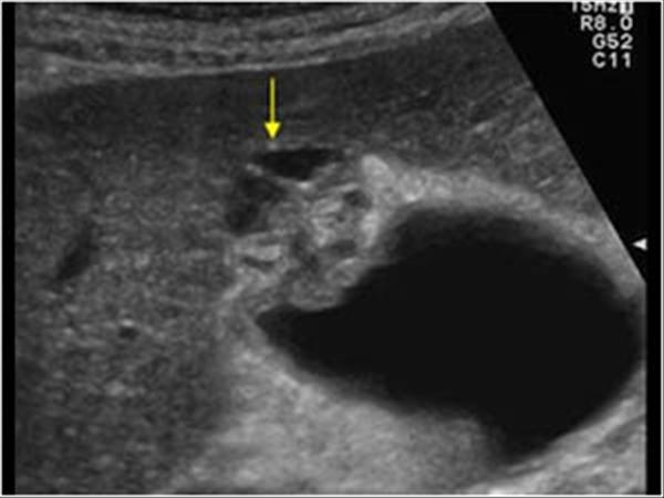 Abdomen and retroperitoneum | 1.2 Gallbladder and bile ducts : Case 1.2