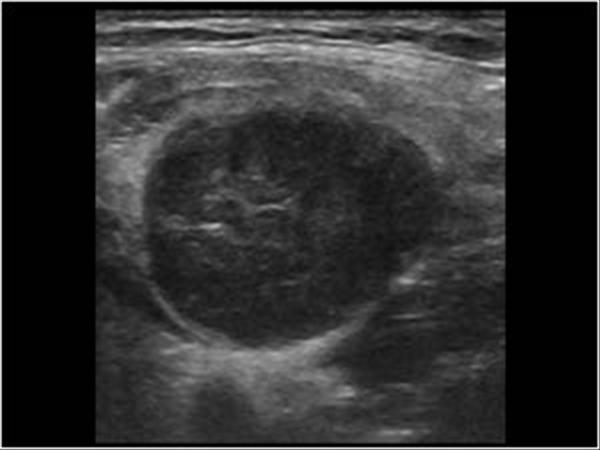 Enlarged Lymph Nodes In Neck Ultrasound
