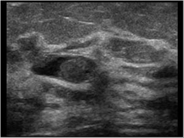 intraductal papilloma breast ultrasound