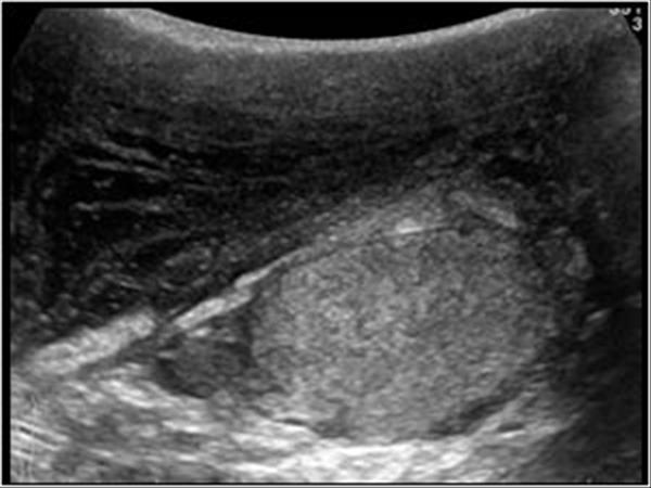 Swelling scrotal Urology