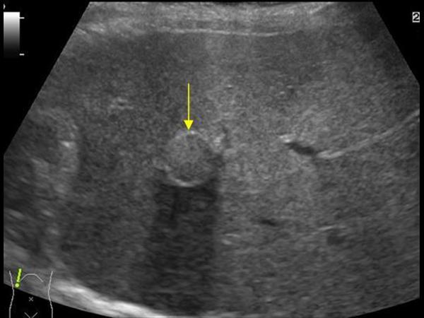 Hepatic Cyst Ultrasound