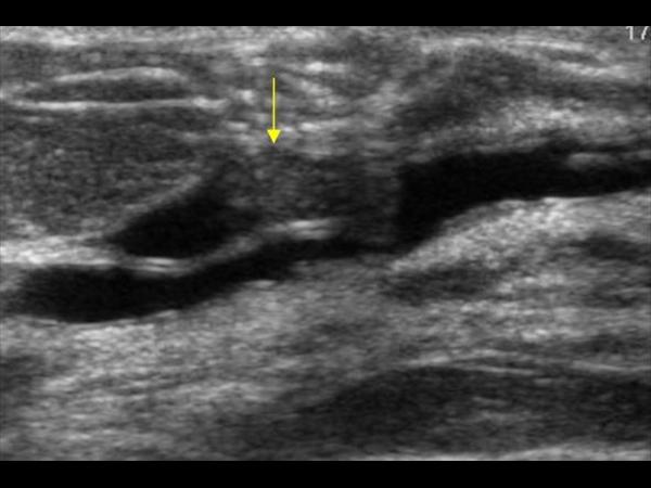 breast papilloma ultrasound appearance