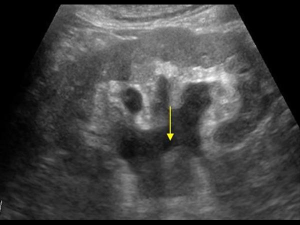 Ureter Tumor Ct extravasation ctisus kidney case ureter contrast scan ...