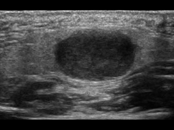 parotid gland tumor ultrasound