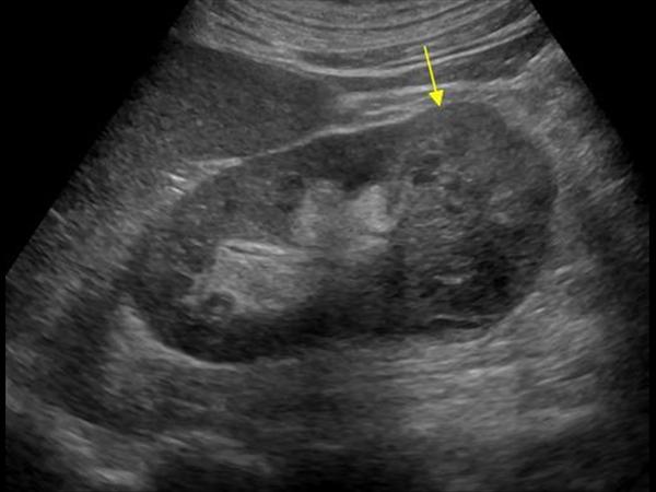 Kidney Tumor Ultrasound
