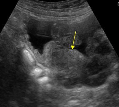 prostate cancer ultrasound
