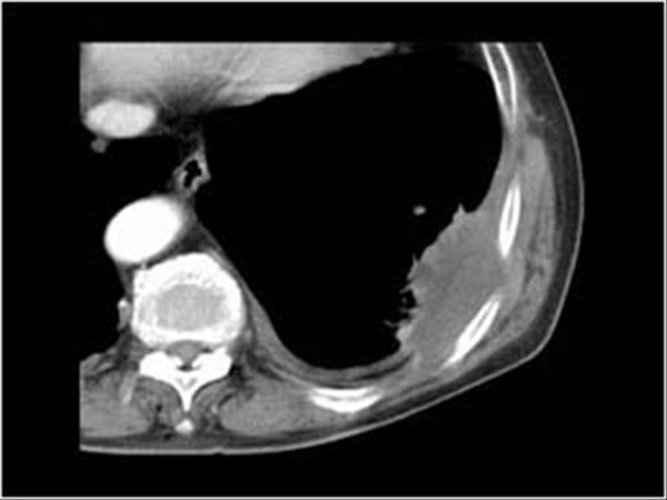 pleural sarcomatoid mesothelioma with an interstitial growth pattern
