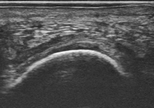 PDF] Ultrasound-guided Diagnostic and Therapeutic Approach to  Retrocalcaneal Bursitis | Semantic Scholar