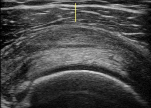 Musculoskeletal Joints and Tendons | 6.1 Shoulder : Case 6.1.17 Bursa ...