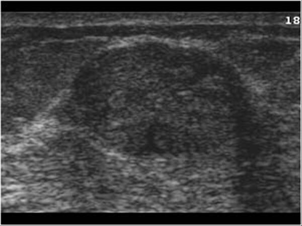 Breast and Axilla | 5.1 Benign lesions : Case 5.1.6 Fibro adenomas