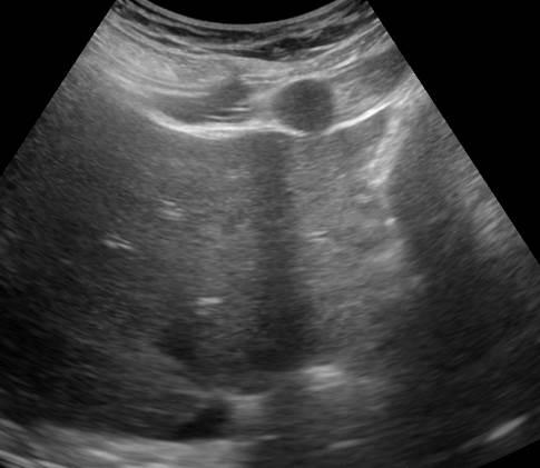 Splenules | Ultrasound Cases