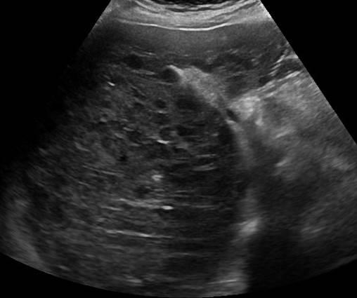 Abdomen and retroperitoneum | 1.1 Liver : Case 1.1.8 Malignant lymphona ...
