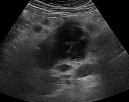 Abdomen and retroperitoneum | 1.8 Various intra-abdominal tumors : Case ...